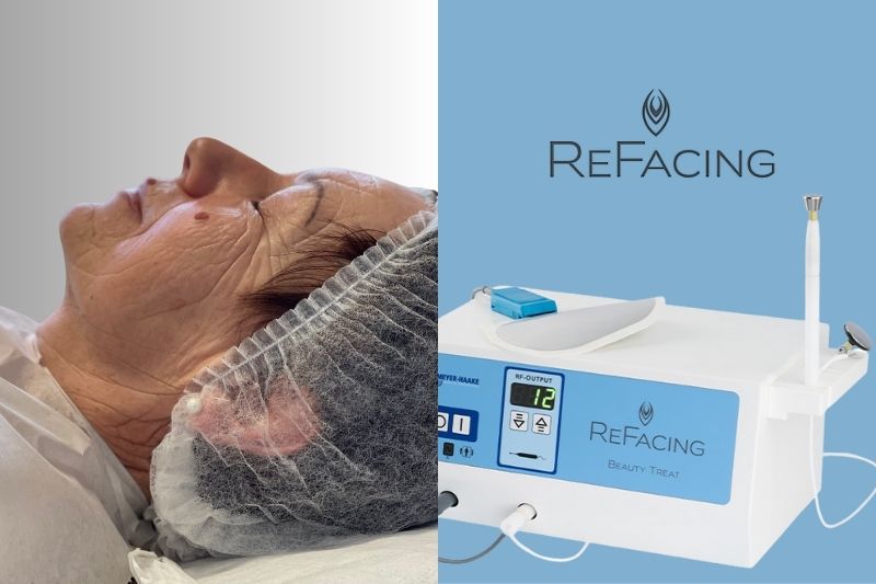 RF ReFacing Radiofrequenz Preis Kosten Behandlungskosten